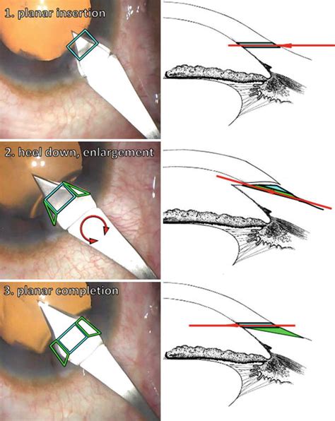 cpt code for trabeculectomy with mitomycin c|Coding for Minimally Invasive Glaucoma Surgery